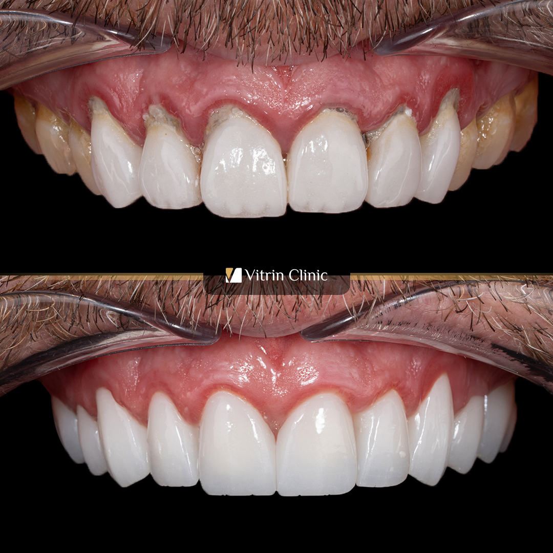 Full Mouth Dental Crowns in Turkey: Cost, Materials, Process & Results